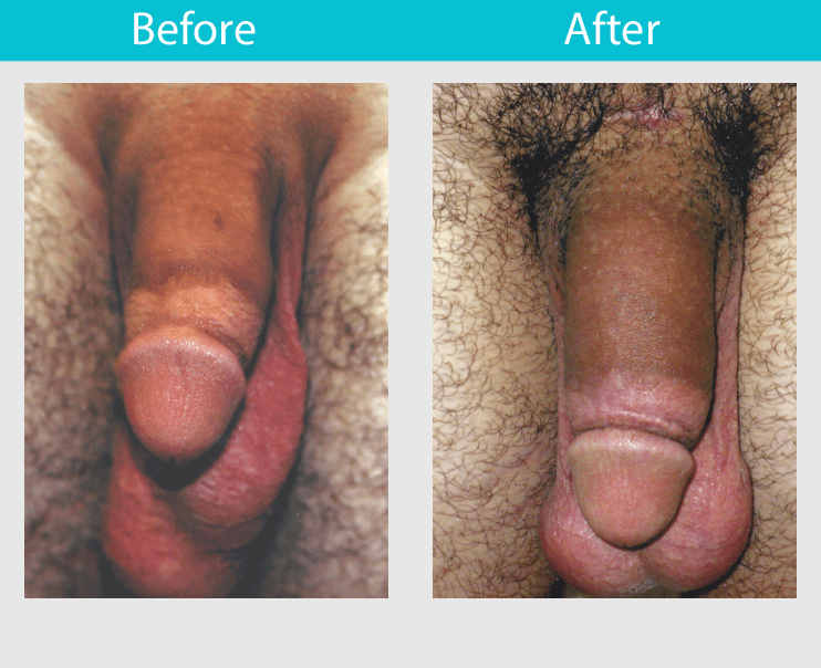 before and after penis handjob savory for savourypenis enlargement pictures...