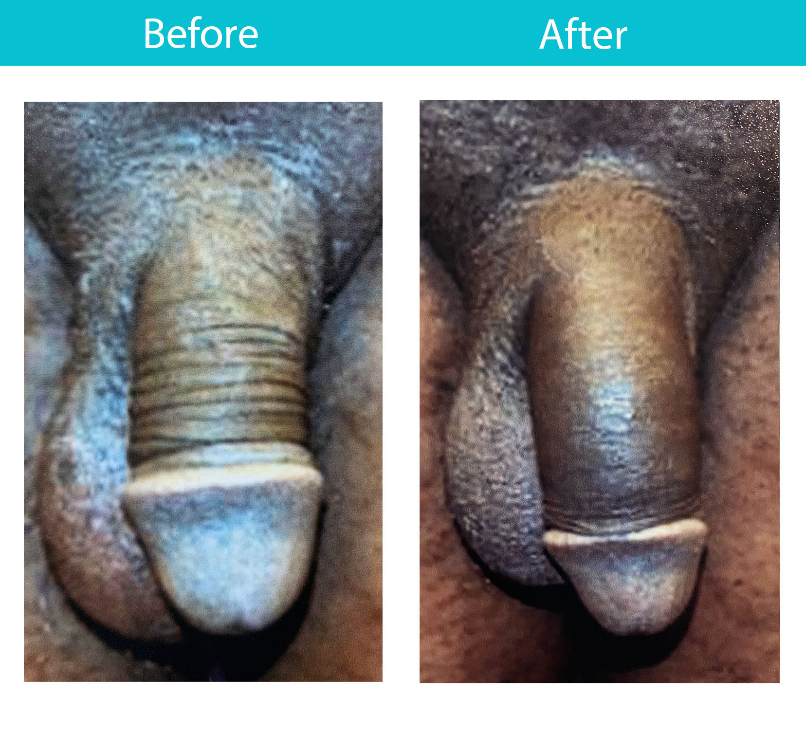 Antes y después del procedimiento de relleno dérmico — Dr. Heller, Nueva York