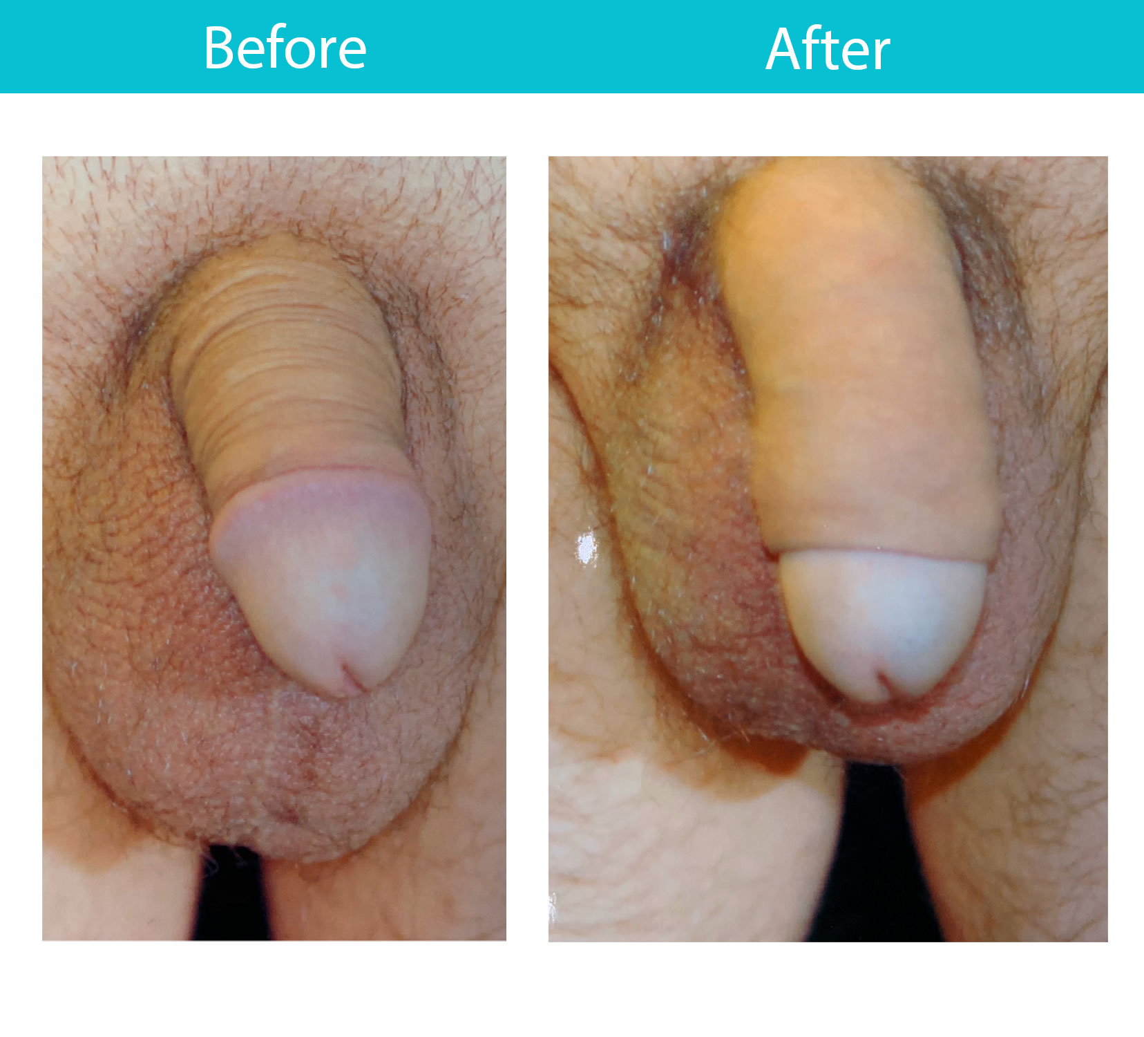 Antes y después del procedimiento de relleno dérmico — Dr. Heller, Nueva York