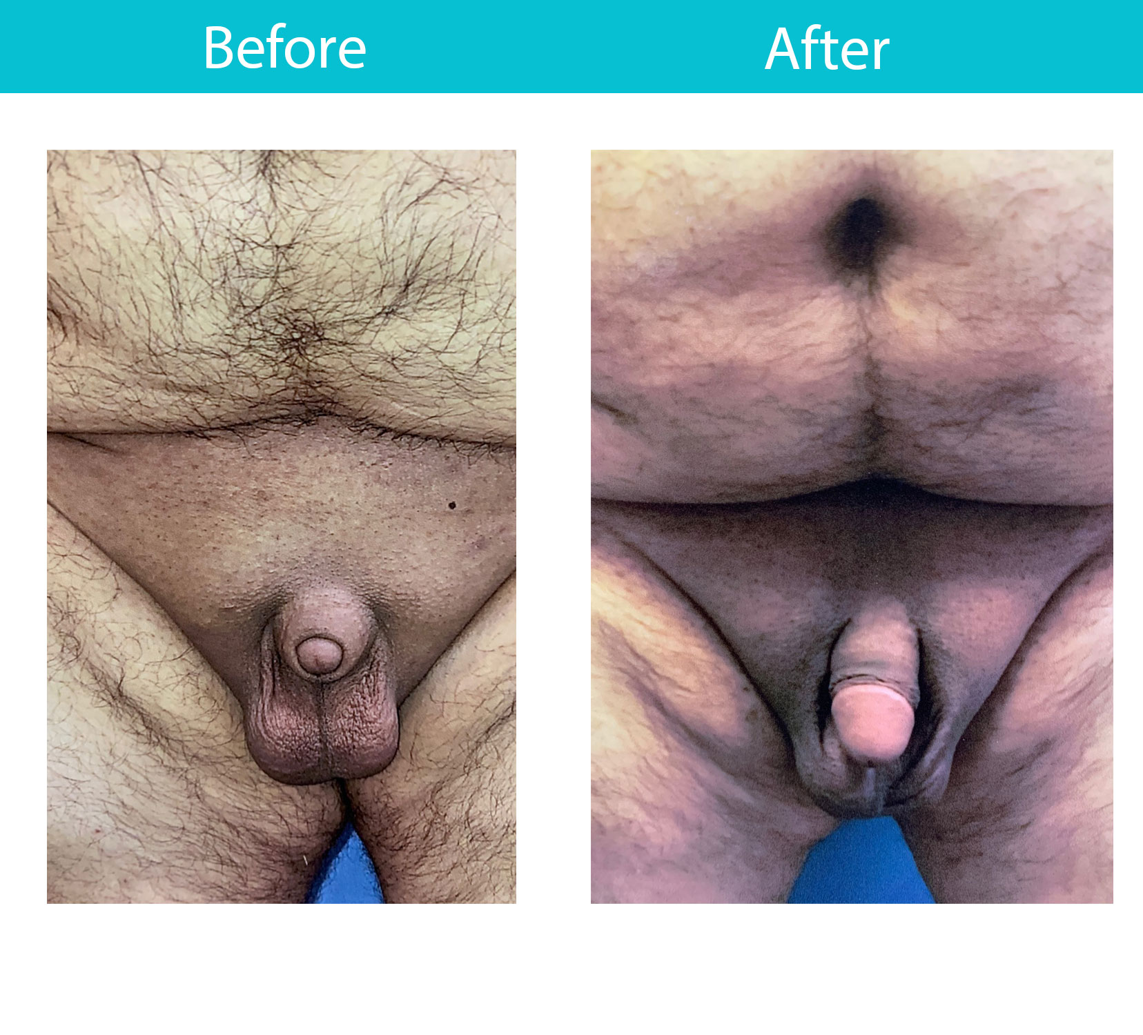 Antes y después del procedimiento de levantamiento púbico / lipo — Dr. Heller, Nueva York