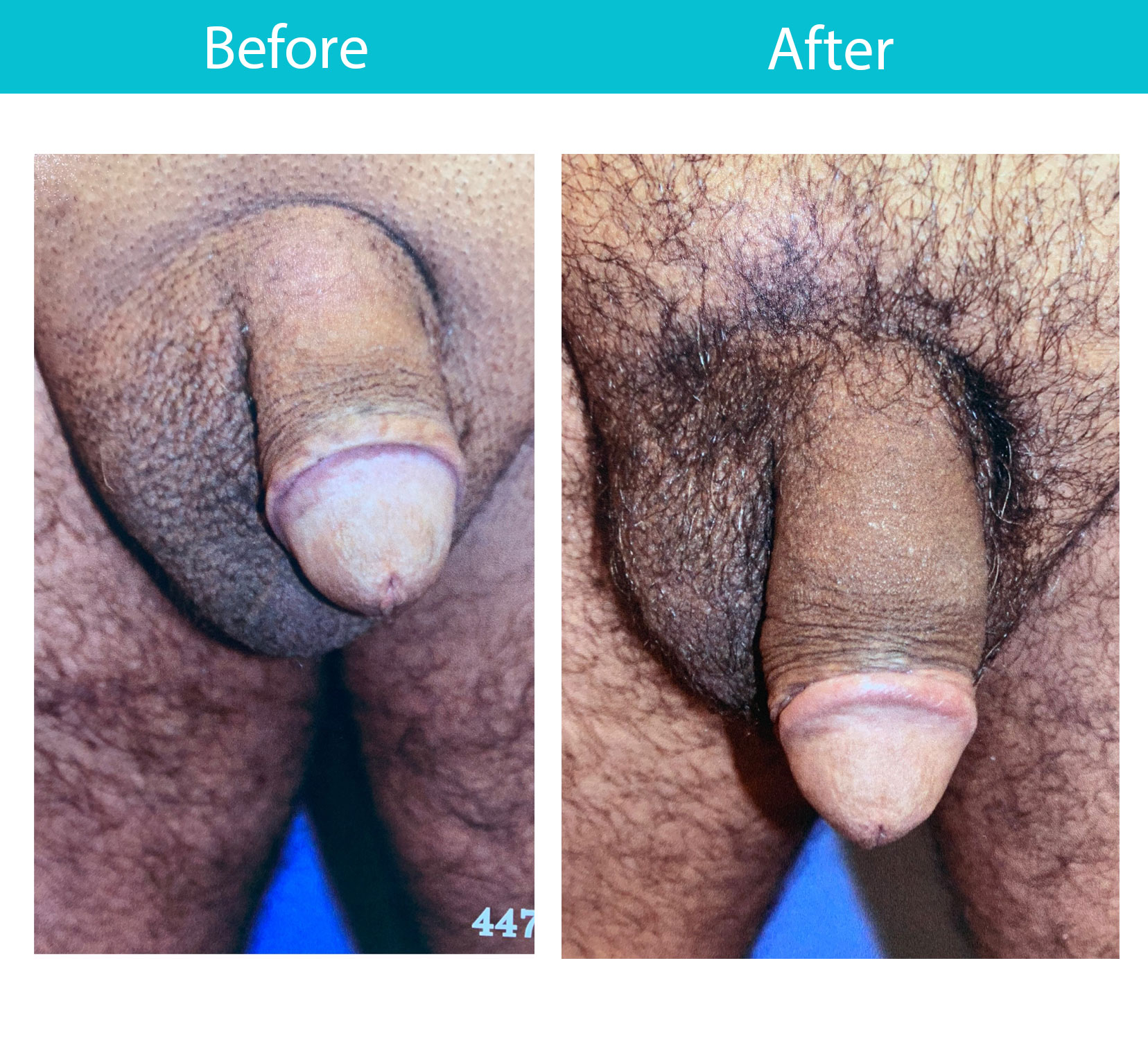 Antes y después del procedimiento de relleno dérmico — Dr. Heller, Nueva York