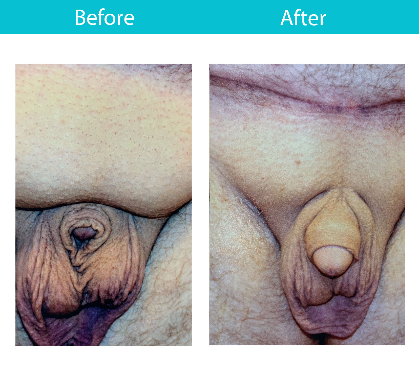 Antes y después del procedimiento de levantamiento púbico / lipo — Dr. Heller, Nueva York