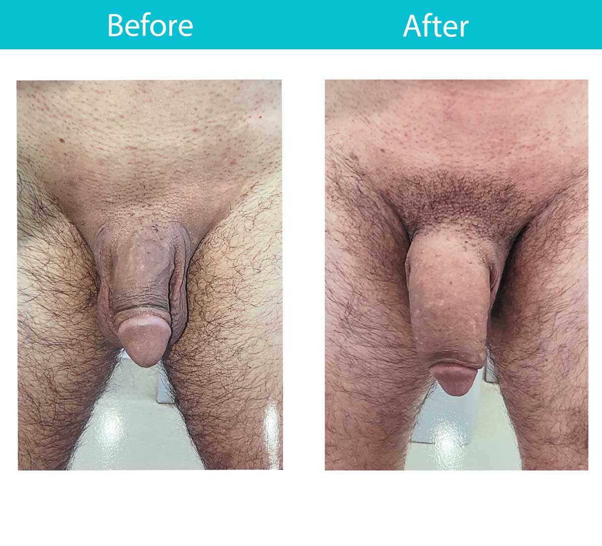 Antes y después del procedimiento de relleno dérmico — Dr. Heller, Nueva York