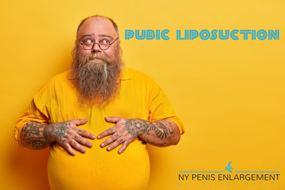Liposucción púbica en Nueva York y Nueva Jersey con el Dr. Elliot Heller