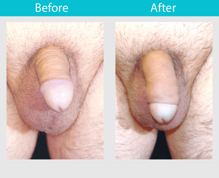 Slide 8--32 year old man had fat transfer to increase girth 0.75 inches and increase length 1.5 inches.