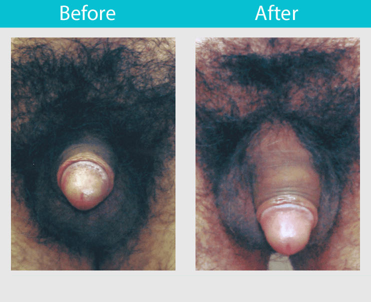 Slide 22--46 year old man had ligament release with fat transfer. His length was increased 2.3 inches and his girth was increased 1.75 inches.