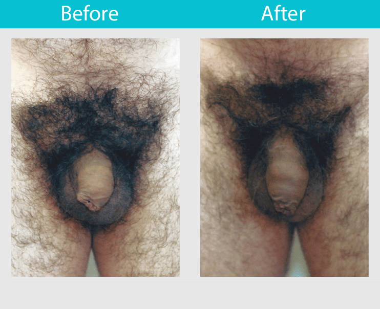 Slide 23--57 year old man had a ligament release procedure with fat transfer. The patient had one additional fat injection. The girth was improved 2 inches and the length was improved 2.25 inches.