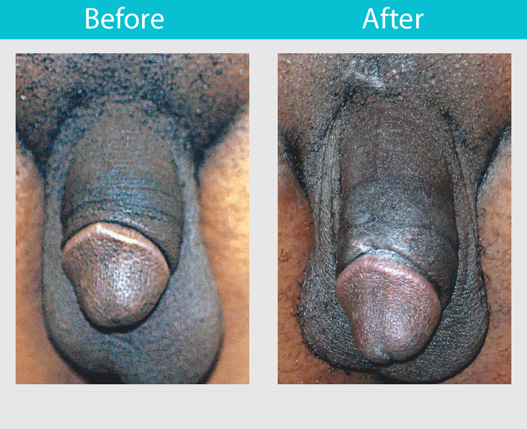 Slide 24--32 year old man who had the ligament release procedure with an Alloderm implant. His length was increased 1.5 inches and girth was increased 0.75 inches.