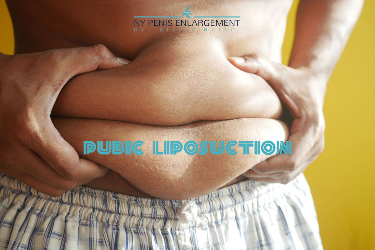Pubic Liposuction for Penis Enlargement in New York and New Jersey